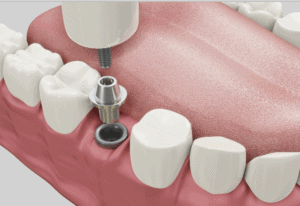 איור של השתלת שן בתוך חלל הפה