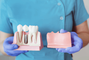רופא שיניים מציג סוגים שומנים של שיניים להשתלה